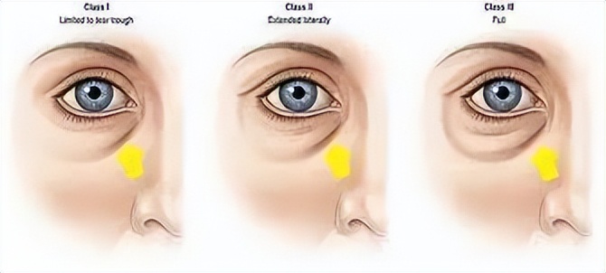 泪沟的克星是什么牌子,眼袋泪沟的克星