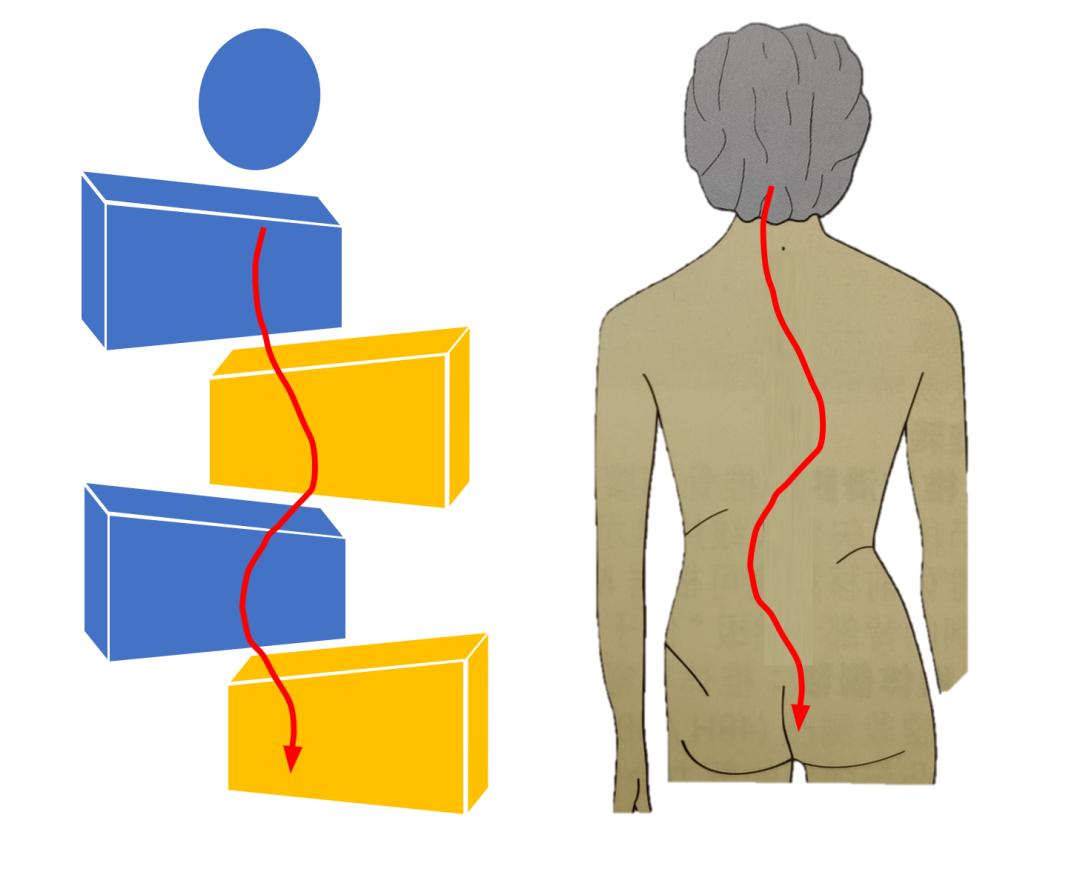 成人脊柱侧弯往哪弯,成年人脊柱侧弯怎么矫正