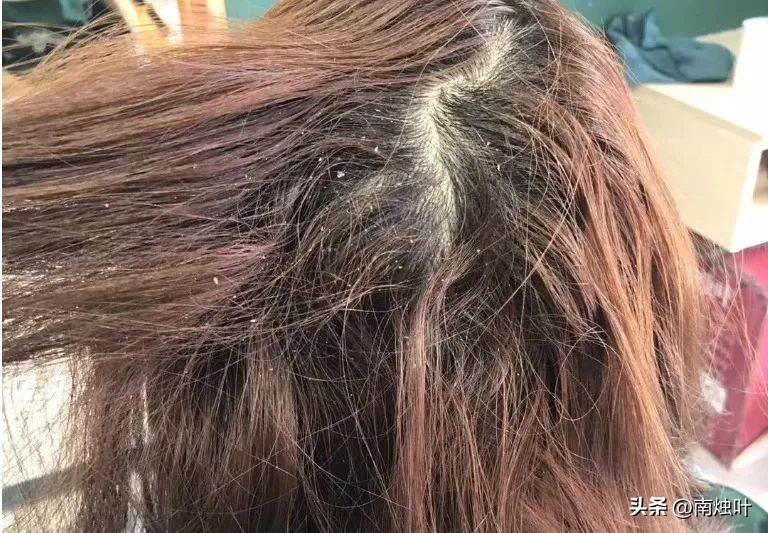 洗发水为什么越洗越多头屑,为什么用海飞丝洗头头屑越洗越多