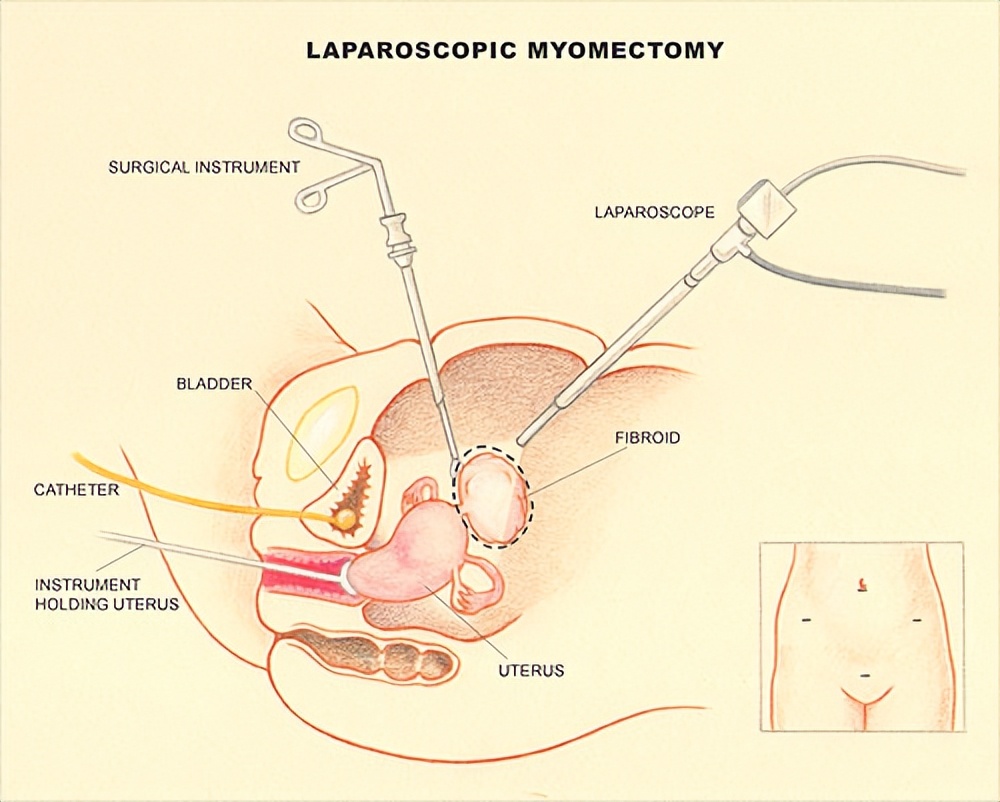 漯河治疗子宫肌瘤最好,齐鲁医院治疗子宫肌瘤最好的专家