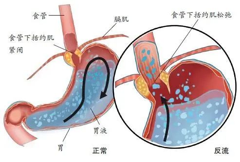 吃完饭「泛酸」的人，食管默默承受患癌风险……