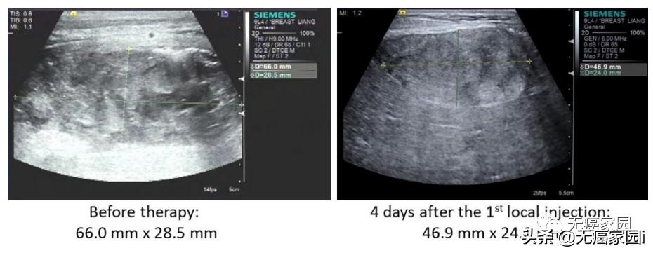 12年化疗失败，干细胞移植复发，CAR-NK疗法让癌症患者完全缓解
