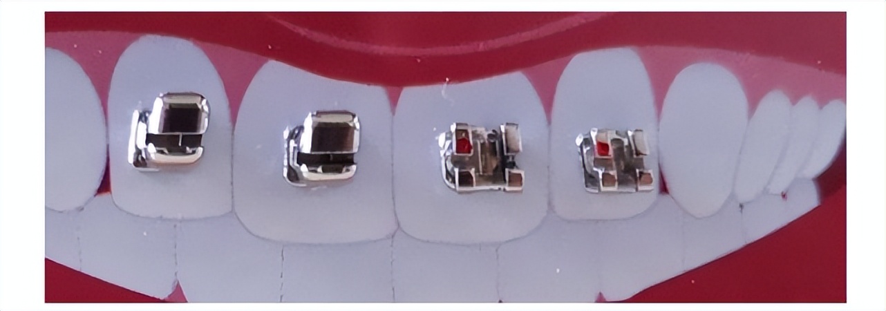 金属自锁托槽经常口腔溃疡怎么办,戴托槽要怎么防止口腔溃疡