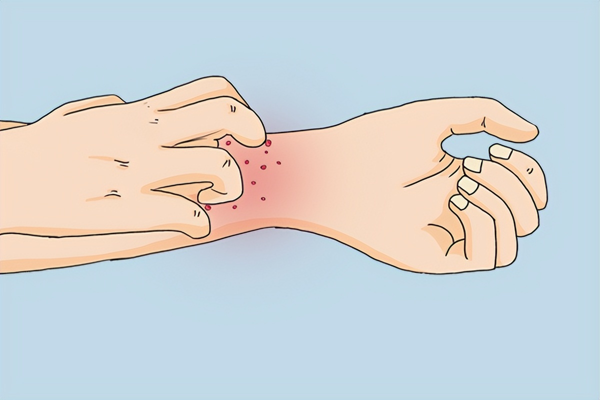 湿疹反复不会好怎么办婴儿,皮炎湿疹和真菌性湿疹有区别