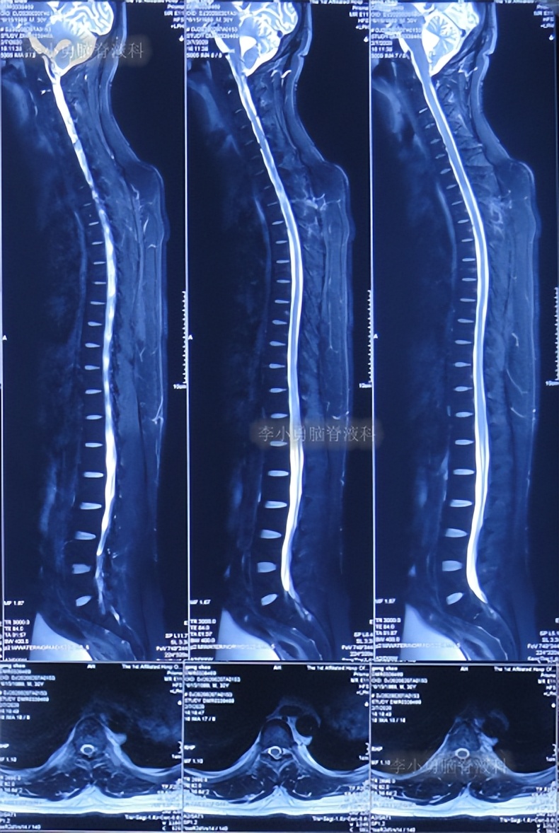 脑积水三脑室造瘘多久能恢复,脑囊虫手术后脑积水