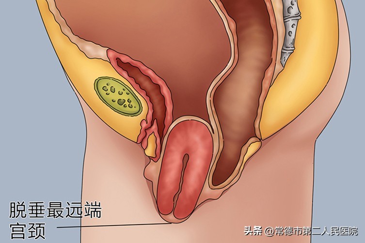 子宫脱垂掉出来一块肉,女性的难言之隐子宫脱垂