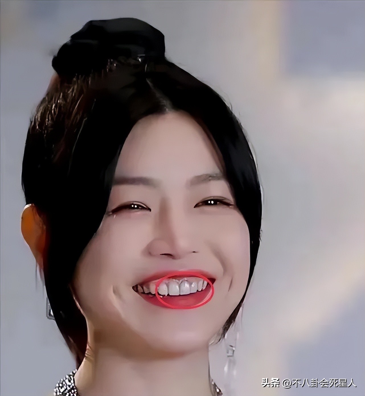 烤瓷牙有多恐怖,烤瓷牙害我一生