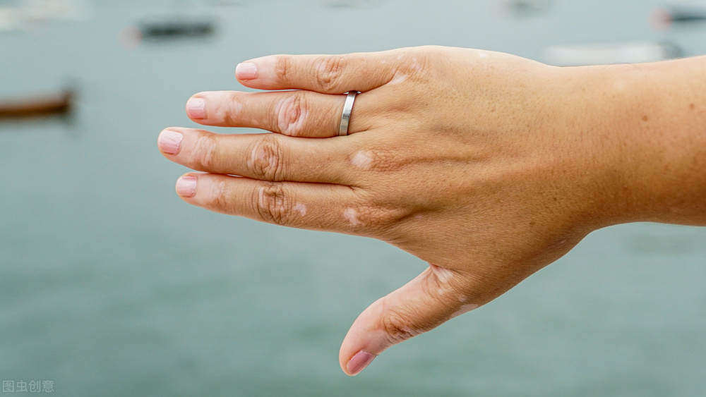 白癜风如何确诊和治疗,白癜风初步诊断方法