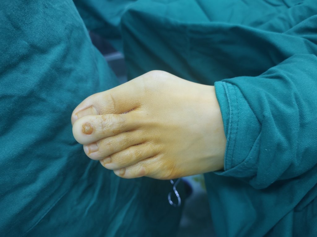 轻度的拇外翻医院有治疗的方法吗,为什么轻度拇外翻不建议做手术