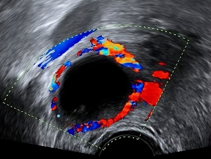 卵巢囊肿超声穿刺手术怎么做的,黄体囊肿与卵巢囊肿的超声区别