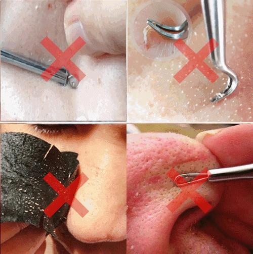 鼻头长黑粉刺怎么回事图片,鼻梁及两侧起了闭口粉刺