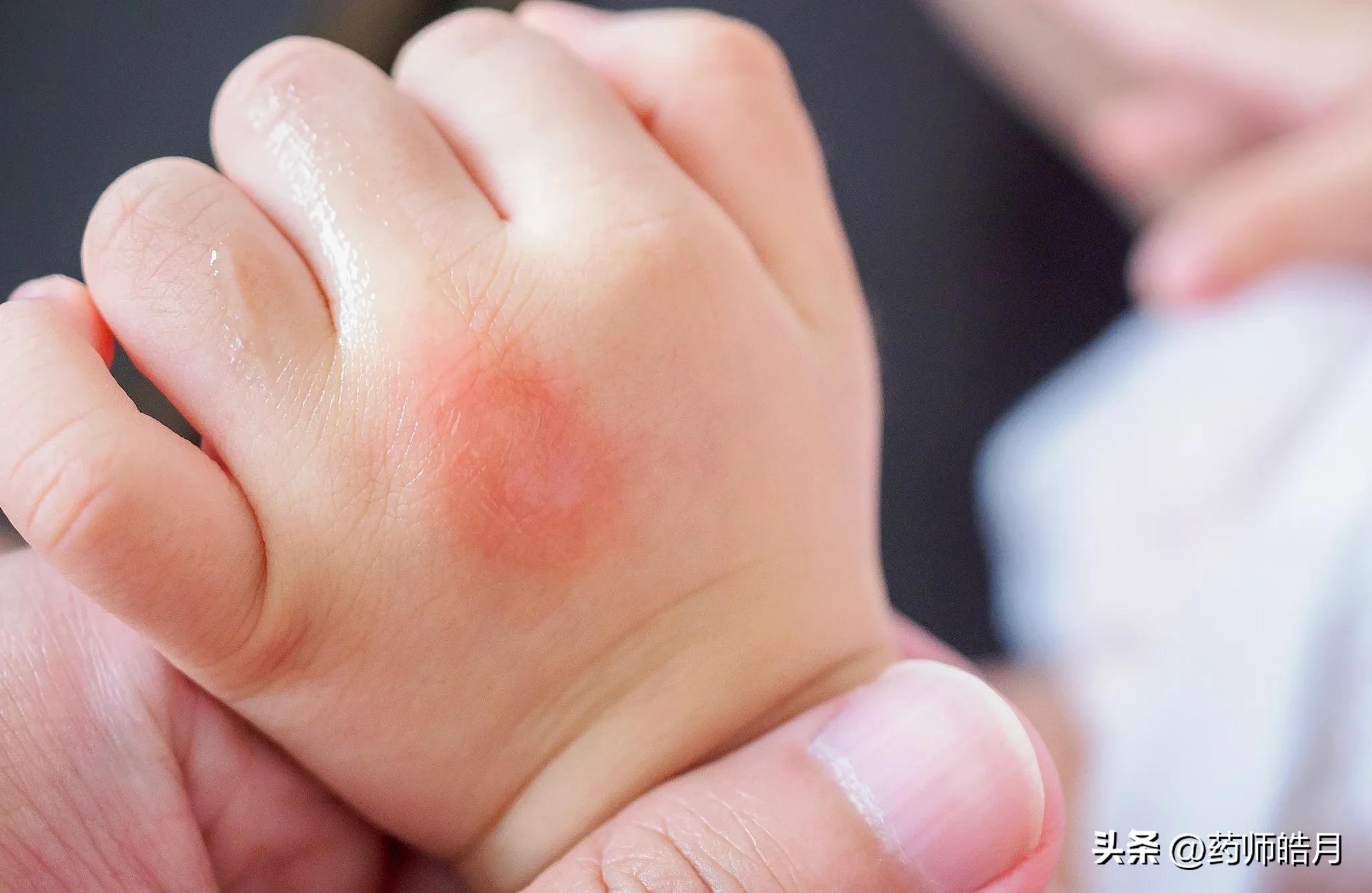 手背长湿疹反复发作如何除根,湿疹反复怎么办教你一招去除