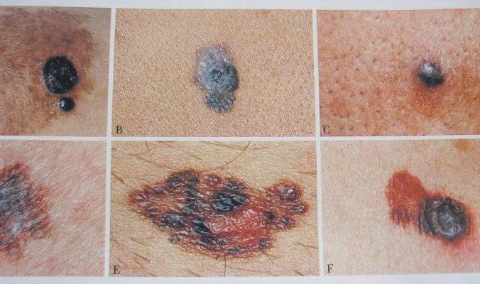 长在身体什么部位的痣容易癌变,脖子突然长痣是癌症的症状