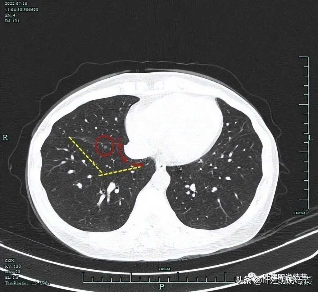 2cm的肺磨玻璃结节如何处理最合适,年轻女人磨玻璃结节