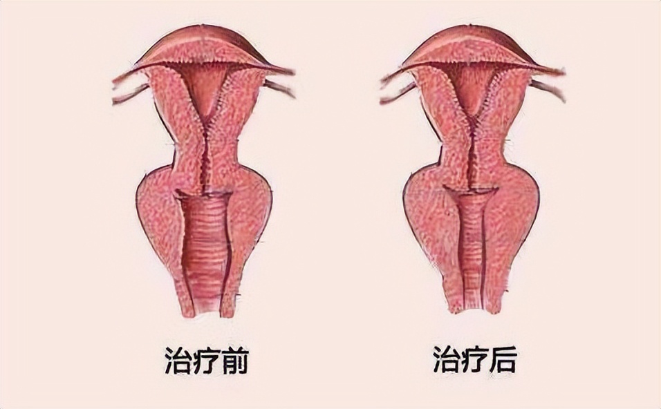 女的外阴突然肥大怎么回事,女外阴肥大有什么影响