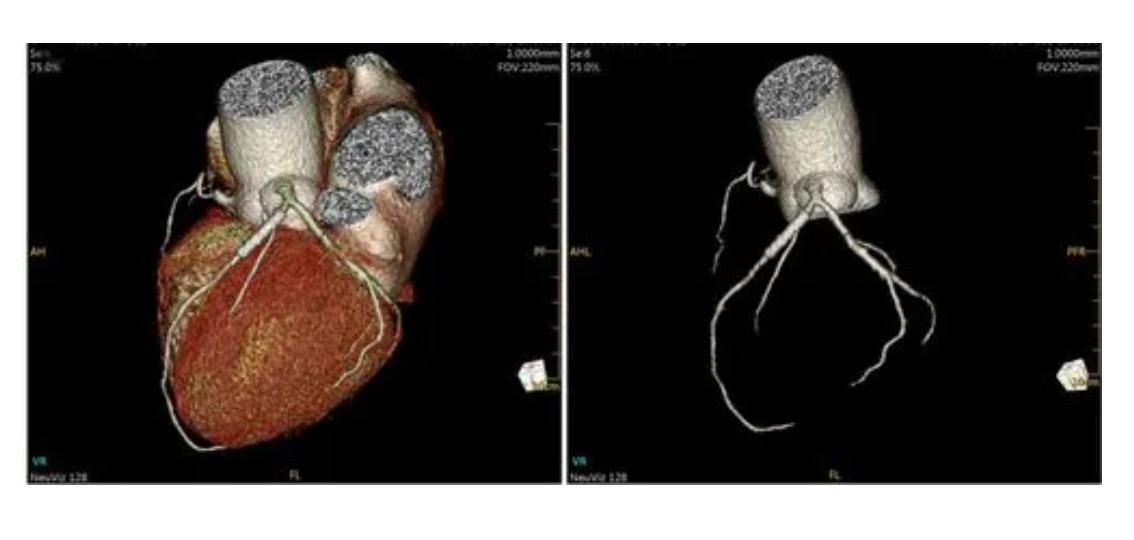 pet-ct查癌准确率,专家揭秘查癌神器petct并非万能