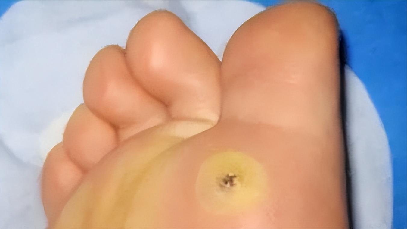 小孩脚底板磨出茧子走路特别疼,脚底板爱进风什么原因