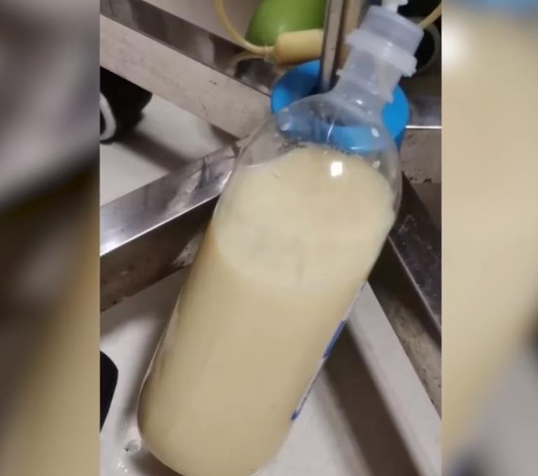 32岁女子连吃数顿火锅血呈“牛奶色”,医生:为其滤出500毫升黄色富血脂血浆