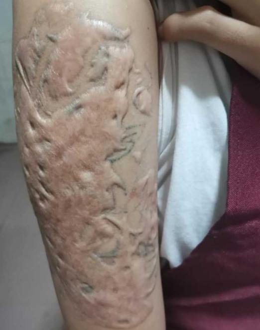 去除纹身过程有多痛,纹身的真相