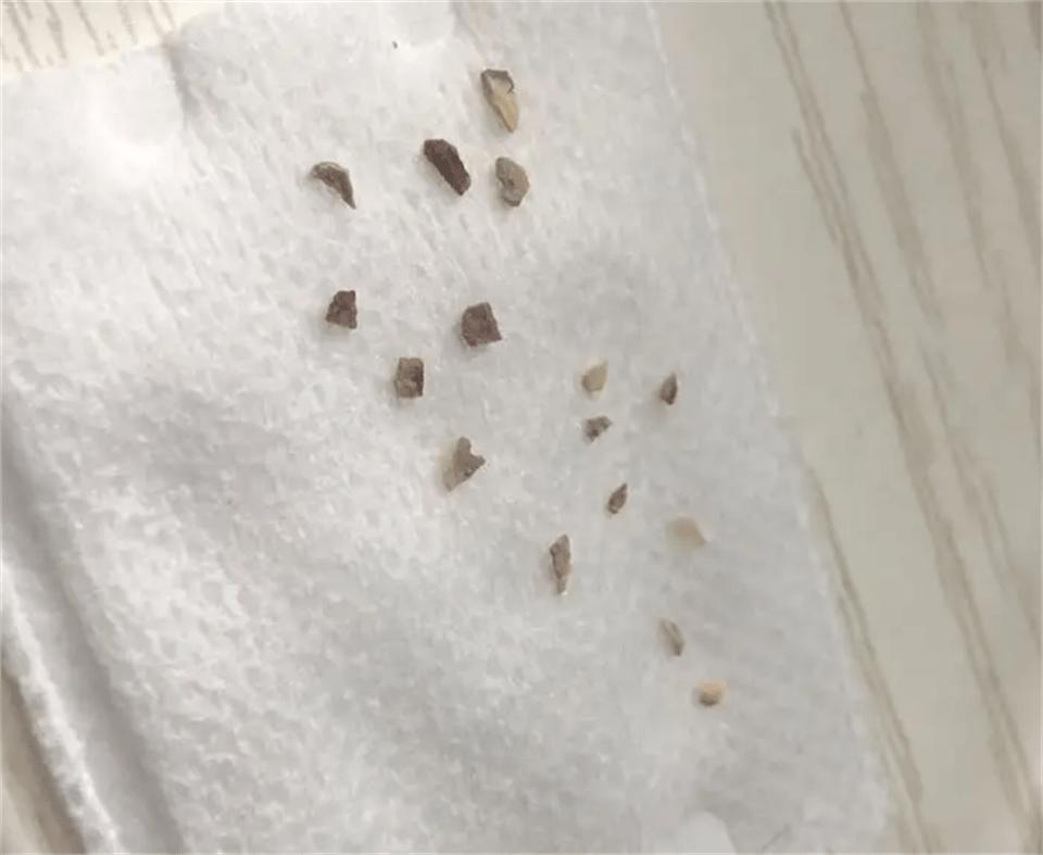 牙垢牙结石自动脱落小妙招,牙结石立刻脱落小妙招