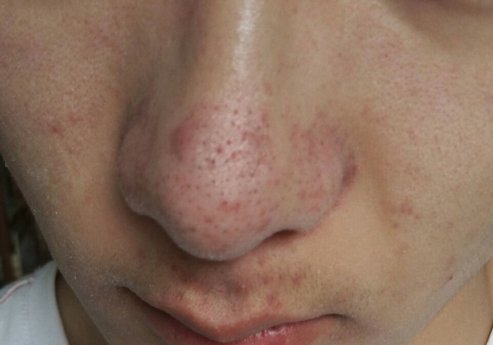 毛孔堵塞毛孔发黑怎样清理,毛孔长螨虫堵塞毛孔怎么办