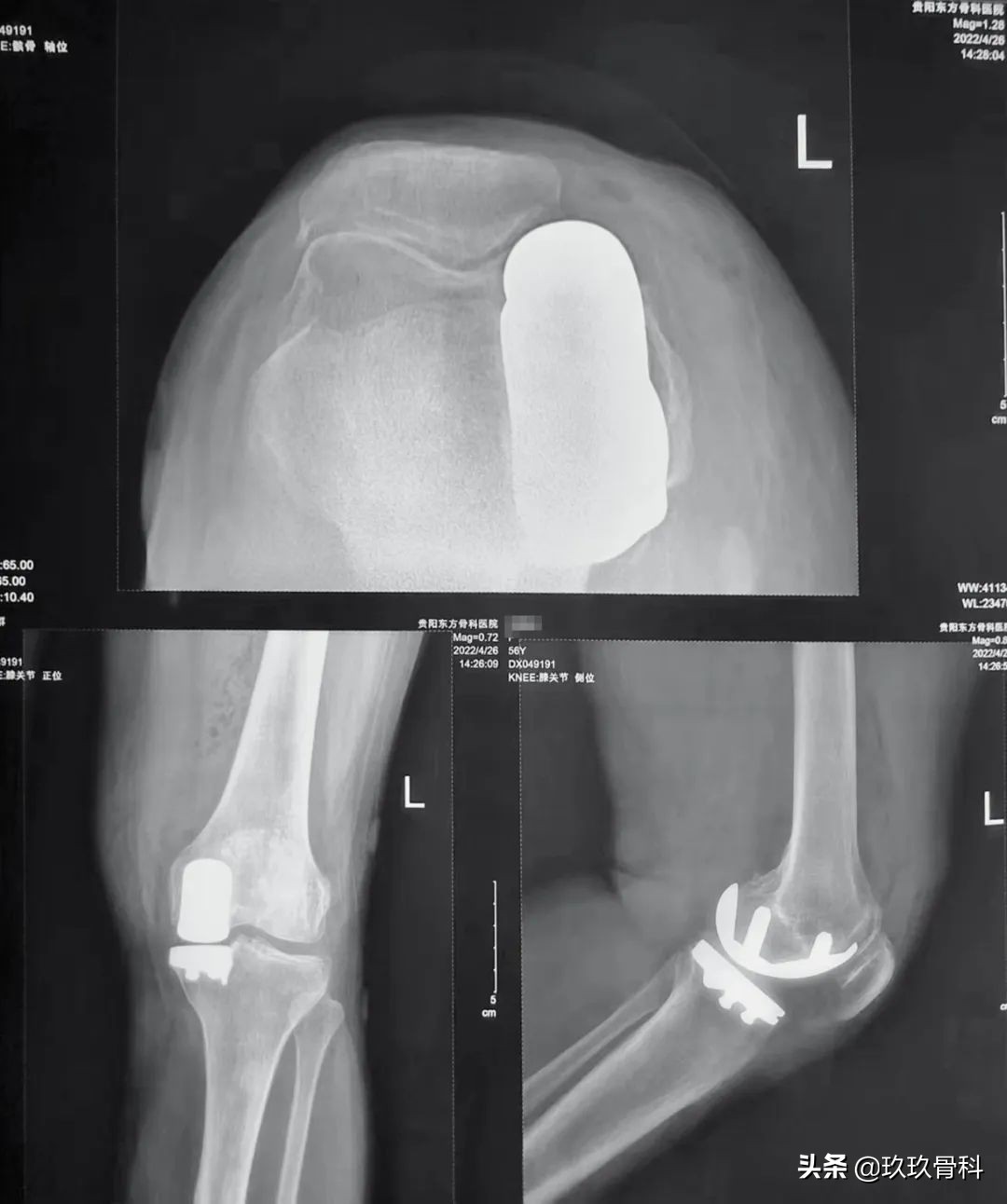 力达康XU单髁假体治疗“双膝”骨性关节炎——贵阳东方骨科医院