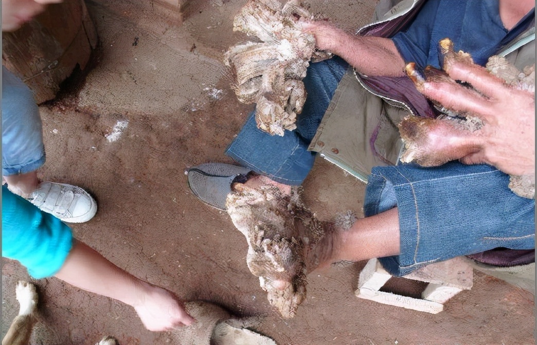 男子手长满树疙瘩是什么病,男子手长满树疙瘩手术了吗