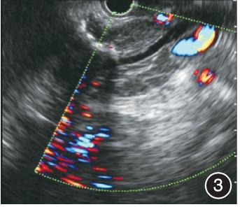 超声内镜诊治合并假性囊肿的沟槽状胰腺炎1例