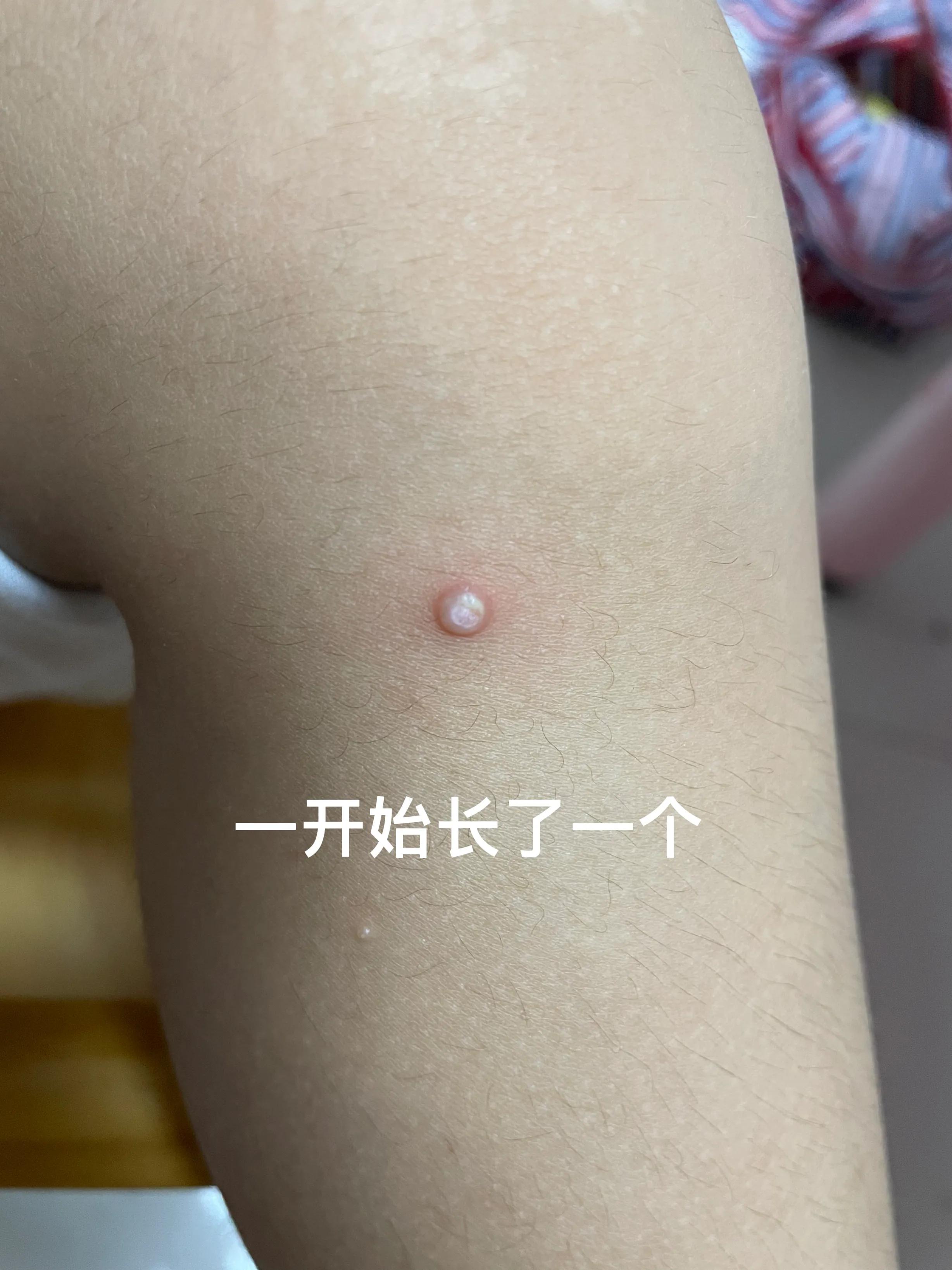 包皮传染性软疣自愈,传染性软疣多久可以自愈