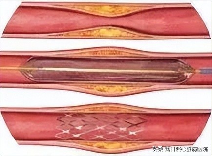 腿脚发凉别大意可能是大病,腿脚冰凉是不好的征兆吗