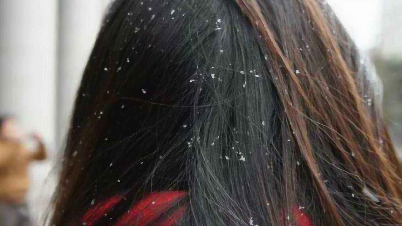 治疗头屑头痒脱发的小妙招,怎么判断是干性头屑还是真菌头屑