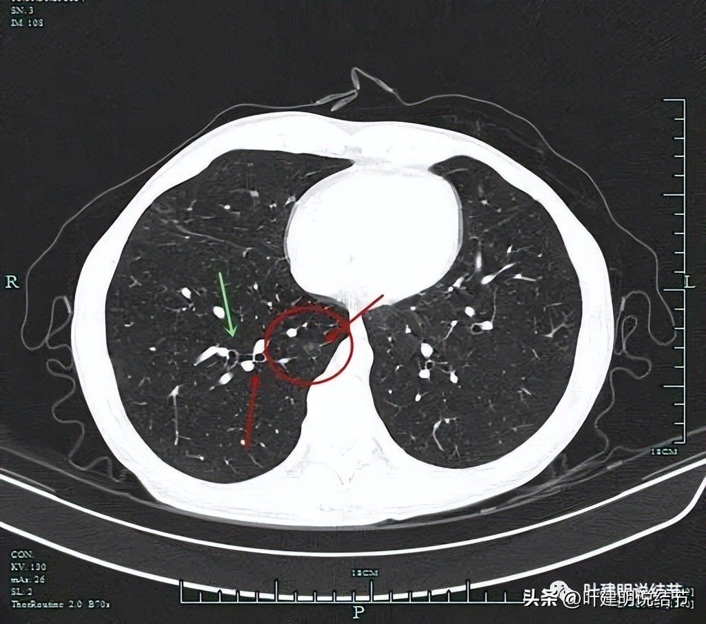 右下叶磨玻璃结节5*4,右下叶磨玻璃样结节多为炎性