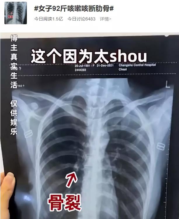 女子因为太瘦咳嗽咳断骨头,太瘦了咳嗽把肋骨咳断