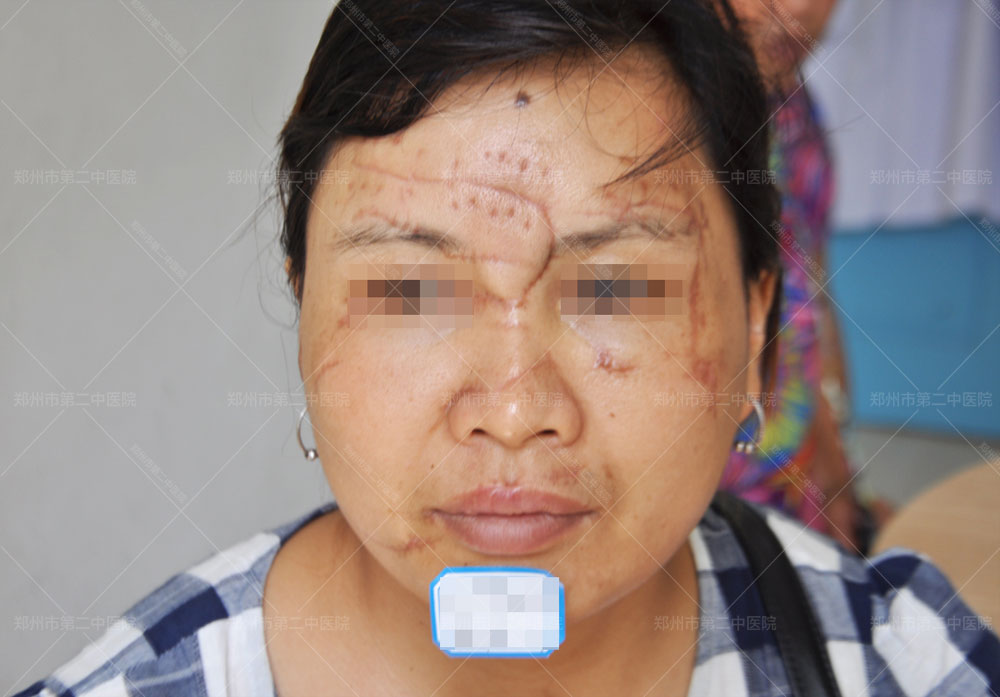 郑州第二中医院治疗疤痕案例,花都区修复脸上疤痕