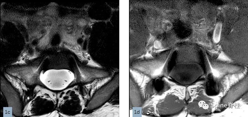 硬膜囊扩张是什么意思,硬膜囊扩张压迫神经