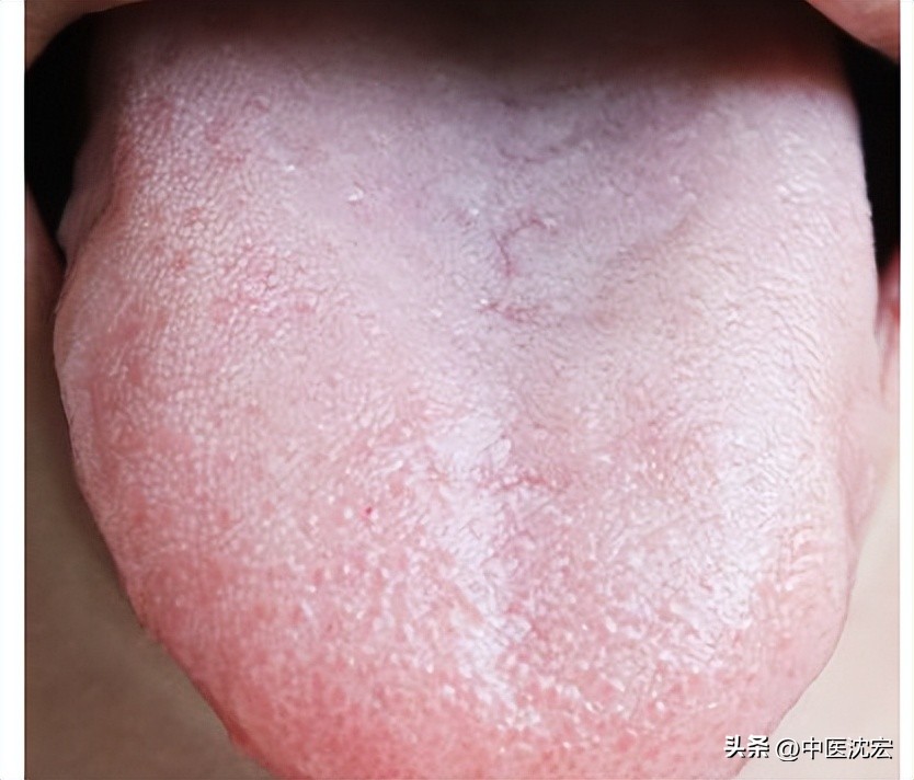 舌红舌头胖,舌暗红但舌苔很白是寒是热