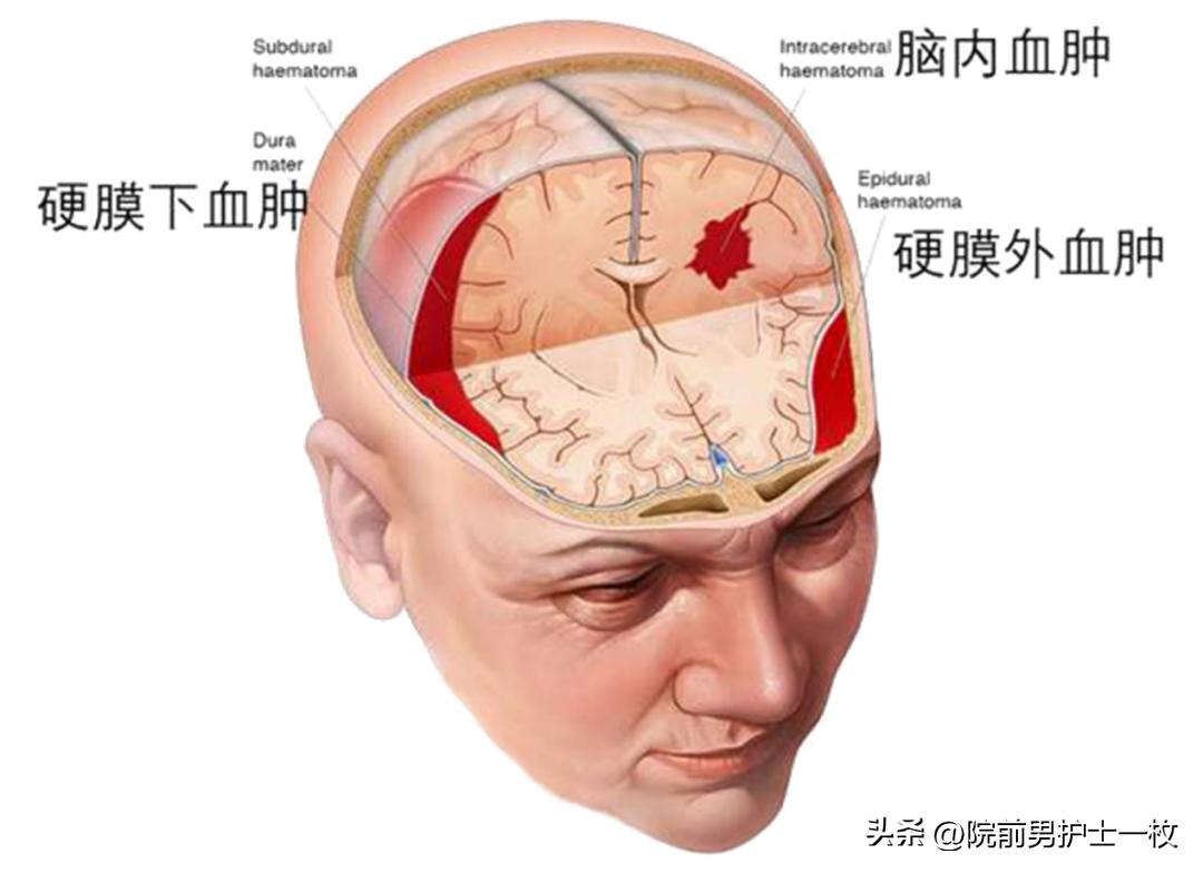 重型颅脑外伤患者急救护理措施,颅脑外伤病人的应急处理