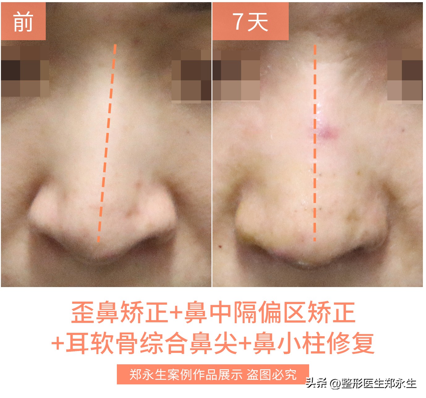 塌鼻和歪鼻如何处理,歪鼻原因
