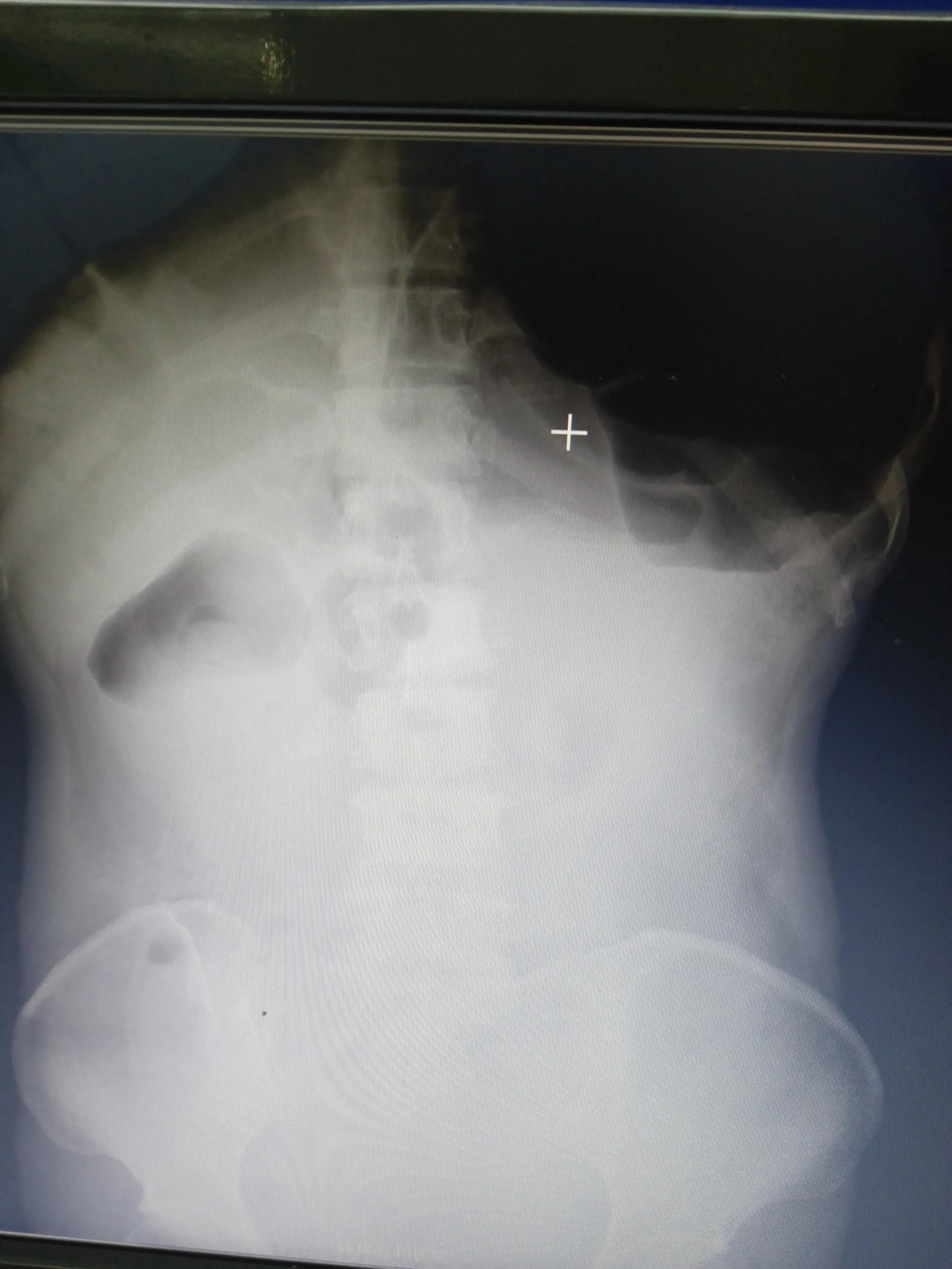 肠梗阻引起胃不舒服怎么办,肠梗阻的症状及治疗长期不排便