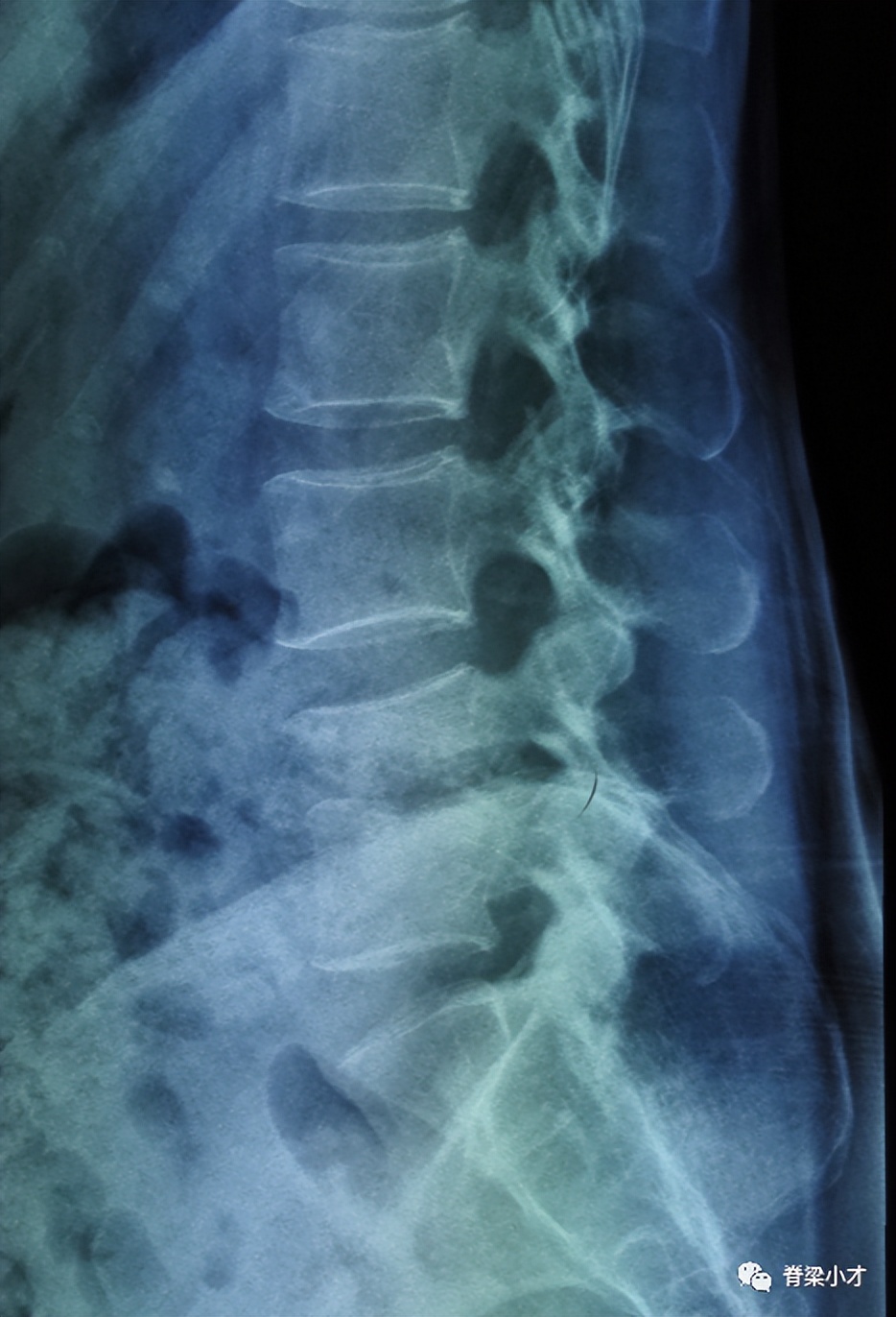 腰椎间盘突出症的诊断与鉴别,腰椎间盘突出和膨出的区别在哪里