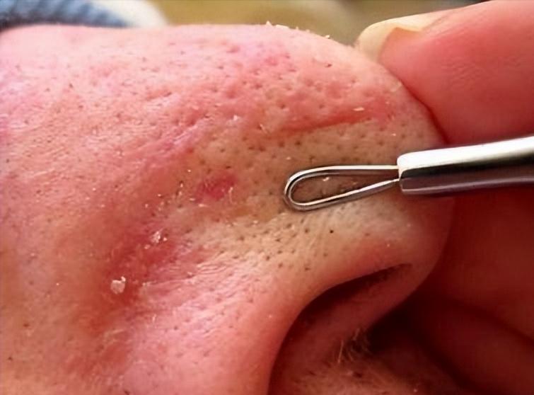 鼻子上有白白的小点可以挤吗,鼻子上黑黑的小点点怎么去除