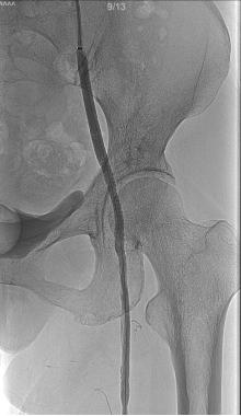 北京专家助力！北京积水潭医院贵州医院疼痛—血管介入科完成一例复杂下肢动脉硬化闭塞症患者的血管再通手术