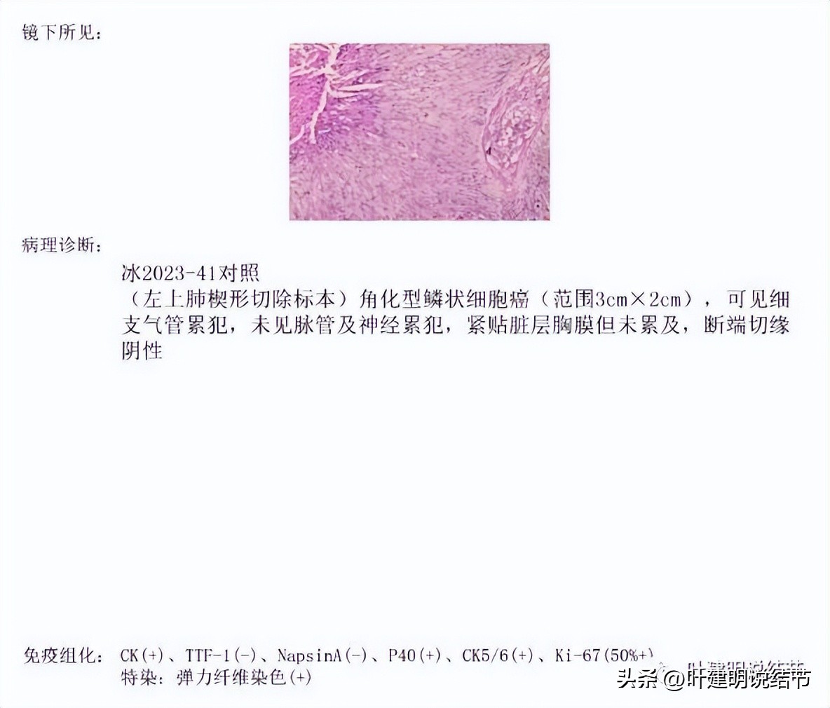 pet判断淋巴结转移,petct判断癌有没有转移准确吗