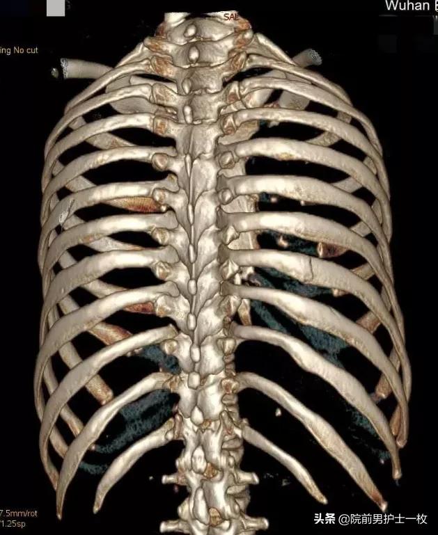 多发肋骨骨折什么意思,多发肋骨骨折怎么治疗