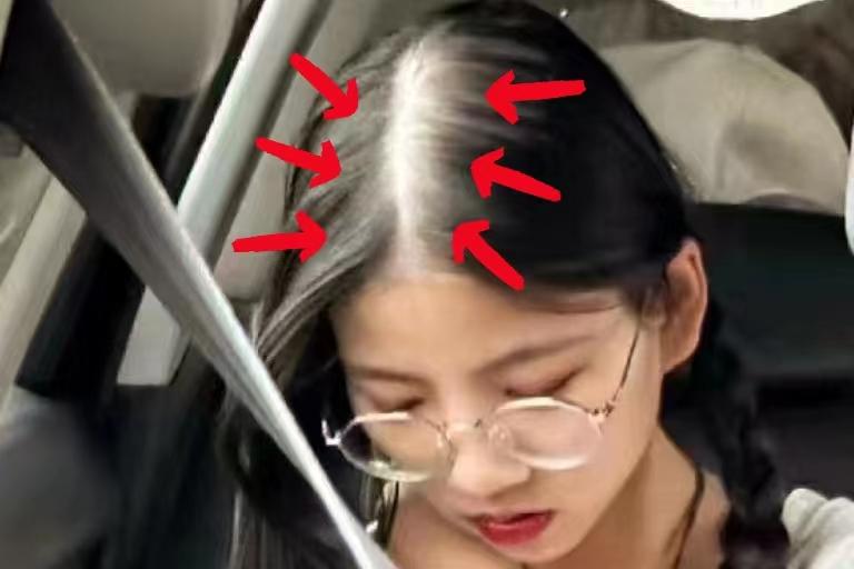 头顶头发稀疏露头皮治疗,头顶稀疏露头皮怎么办