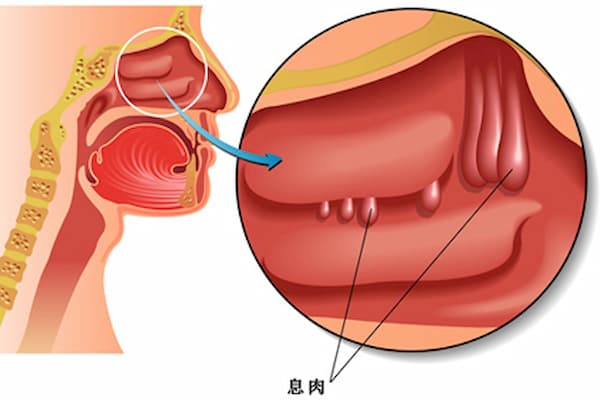 鼻息肉导致鼻塞的最佳治疗方法,鼻息肉有点鼻塞怎么办其它无症状