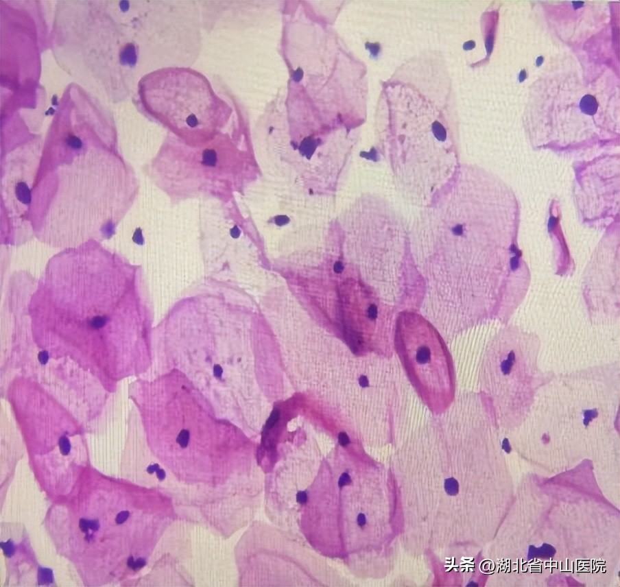 宫颈癌筛查TCT、HPV傻傻分不清，病理科为您来揭秘
