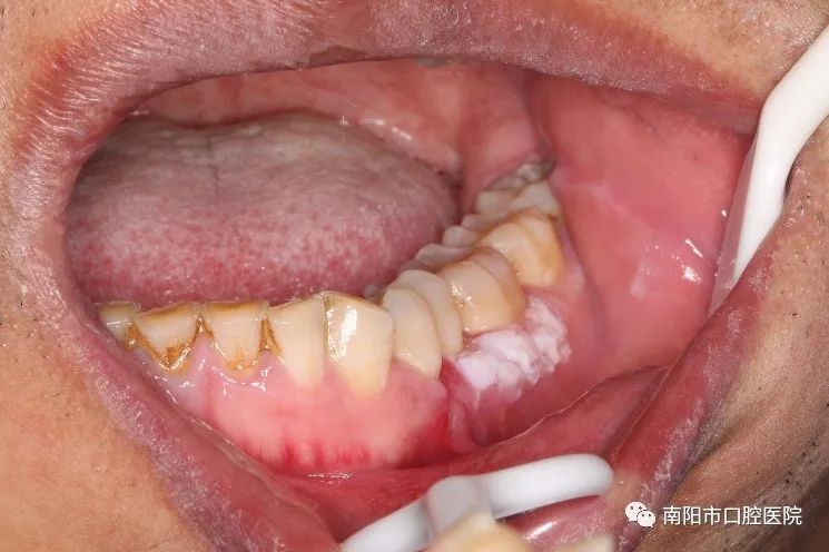 口腔里有白斑怎么治最快,口腔长了白斑怎么回事