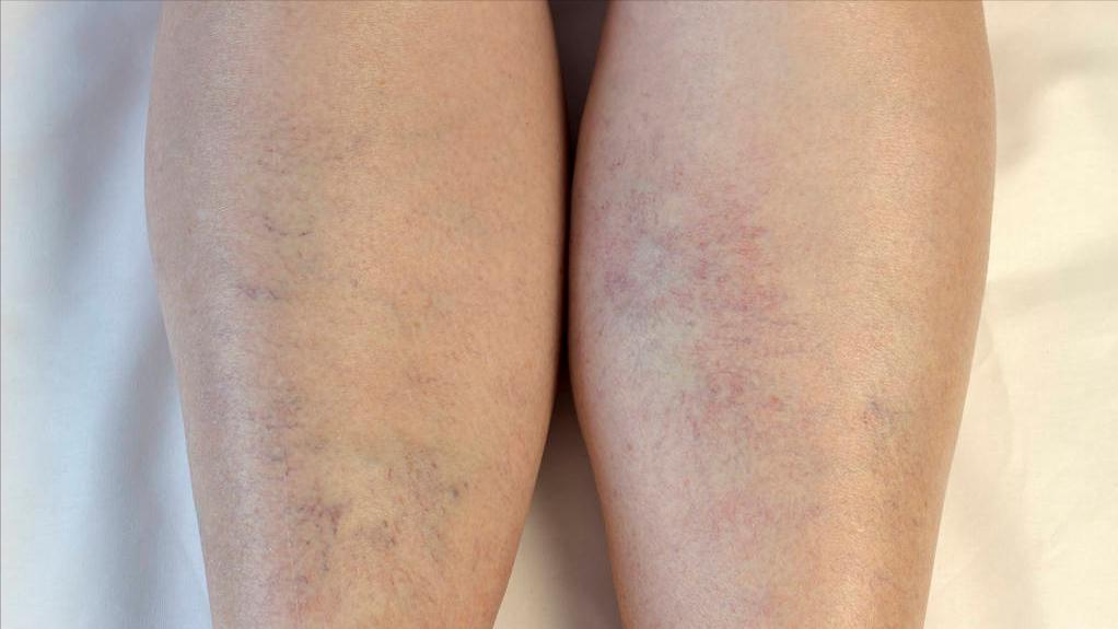 做什么检查可以看出肾病严重程度,要想知道肾有没有问题查什么