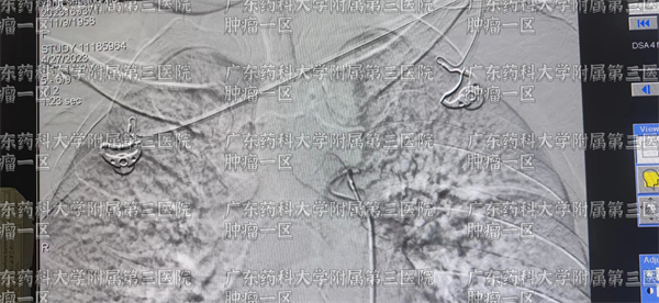 广州现代医院治疗肺癌骨转移,肺癌骨转移中医治疗成功案例视频